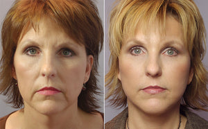 Wrinkles Vs Dermal Fillers: Types, Indications, and Complications